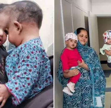 Mjekët turq me sukses ndajnë foshnjet 11-muajshe nga Pakistani pas një operacioni 14-orësh