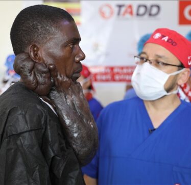 Mjekët turq heqin një masë keloidi 5 kilogramëshe nga pacienti nga Uganda