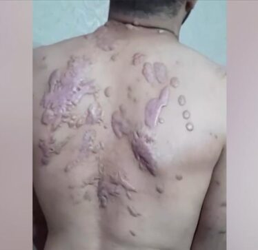 Një vit në burgun izraelit, palestinezi nga Gaza humb syrin dhe pëson djegie kimike nga torturat