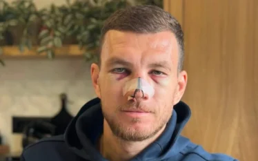 Edin Dzeko publikon gjendjen e fundit pas thyerjes së hundës
