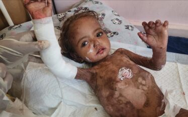 E bllokuar midis urisë dhe sëmundjes, vogëlushja nga Gaza lufton…